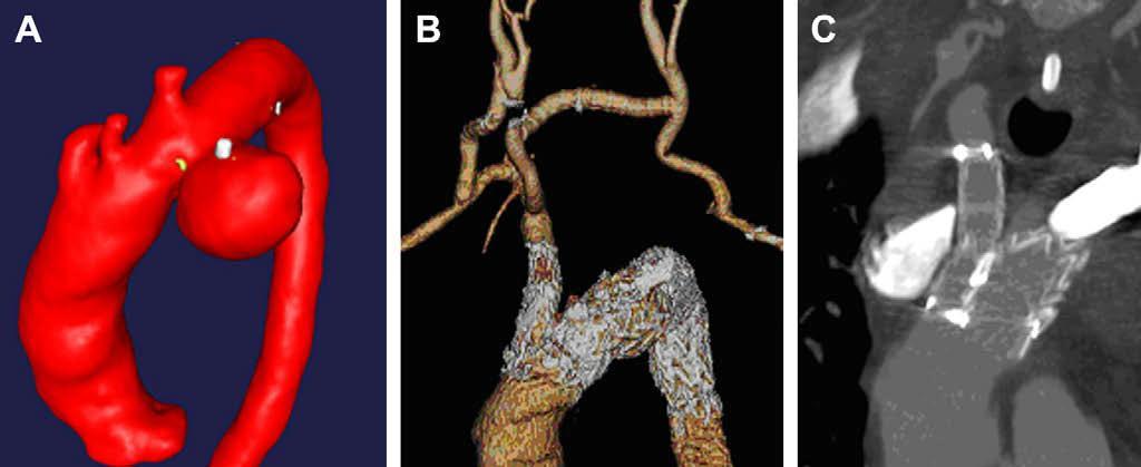 DOUBLE-BARRELL TECHNIQUE Ann Vasc Surg. 2008 Nov;22(6):703-9. Epub 2008 Aug 5. Double-barrel technique for preservation of aortic arch branches during thoracic endovascular aortic repair.