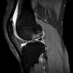 Outside MRI prior to knee