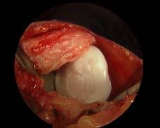 Repeat knee arthroscopy Some fibrocartilage fill, size of lesion increased, new tibial chondromalacia 17 x 16 mm 2014 MFMER