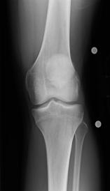 History 29 year old M CC: L knee pain HPI: Basketball game Landed on opponent s foot and twisted his left knee, heard a pop