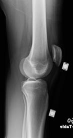 knee past 10 deg flexion due to excruciating pain TTP along patella, negative apprehension,+1 quadrant patellar glide Tight