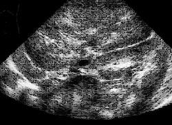 medulla, loss of corticomedullary differentiation Ultrasound - Liver Increased echogenicity +/- ductal ectasia in