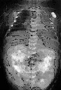 children, mild tubular ectasia similar to medullary sponge kidney MR - few cysts in about half of