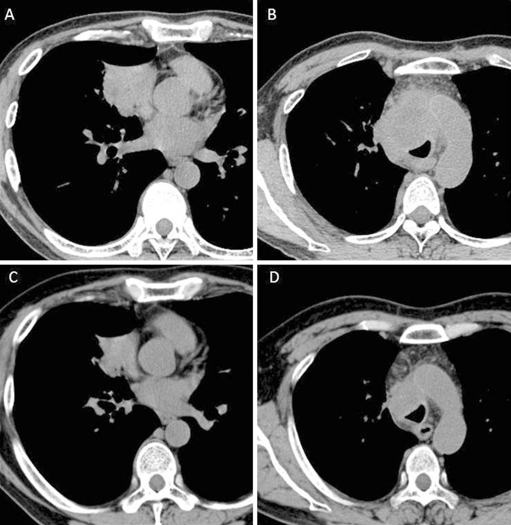 Intern Med 54: 2045-2049, 2015 Figure 1. (A, B) Chest CT revealed a mass in the right middle lobe of the lung and enlarged paratracheal lymph nodes.