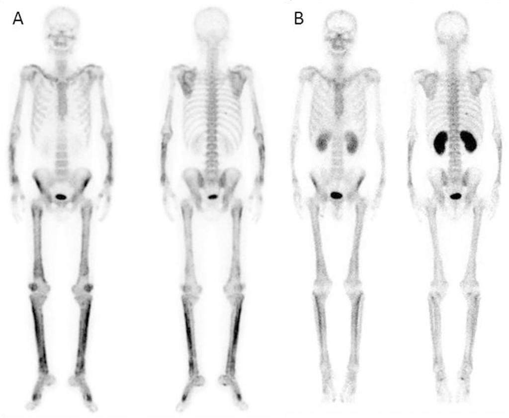 Figure 3. (A) Bone scintigraphy with 99m Tc complexes showed a bilaterally symmetrical linear uptake in the long bones.