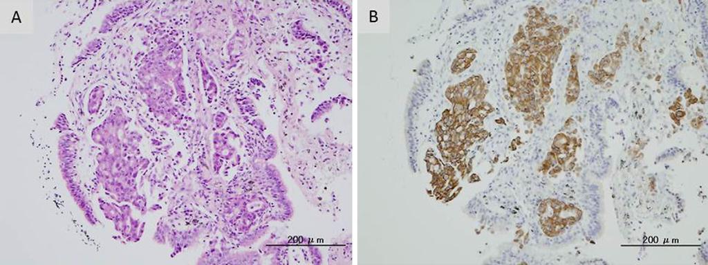 (A) A transbronchial lung biopsy specimen obtained from the tumor in the right middle lobe showed a poorly differentiated adenocarcinoma component with an acinar pattern (Hematoxylin and Eosin