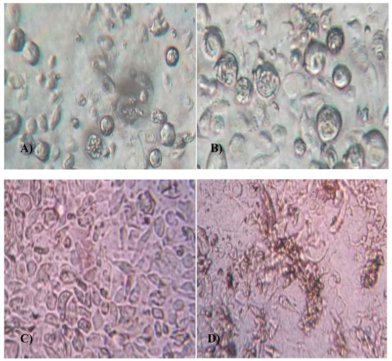 Fig. 3: Shows A) MCF-7 cells before treatment showing actively dividing cells, B) MCF-7 cells after treatment with sample-1 at 512μg/ml concentration incubated for 24hrs showing uncharacterized