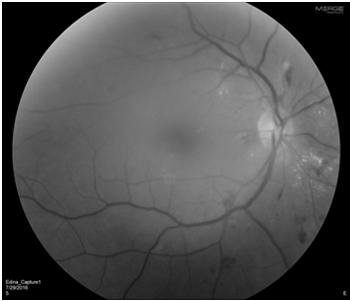 CASE #3: DME and Cataract surgery 59 year old Diabetic female LBS: Unknown HA1c: 9.