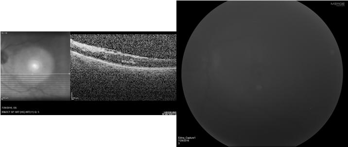 OS>OD that is cloudy and foggy x 1 year. Dense cataracts OS>OD.