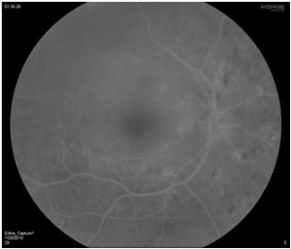 Early FA OD. No view OS due to dense cataract.