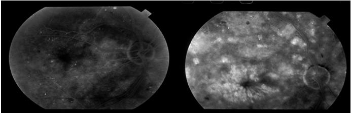 Mod-severe NPDR (difficult to grade) with central DME OS, ERM OS, minimal DME OD, Dense cataracts,