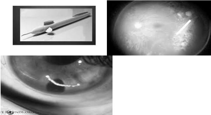 Post cataract surgery CME/DME usually cystoid in pattern to suggest inflammatory cause Dexamethasone implant office injection 3 year study for DME (MEAD study) Mean 4 treatments in 3 years Study 1: