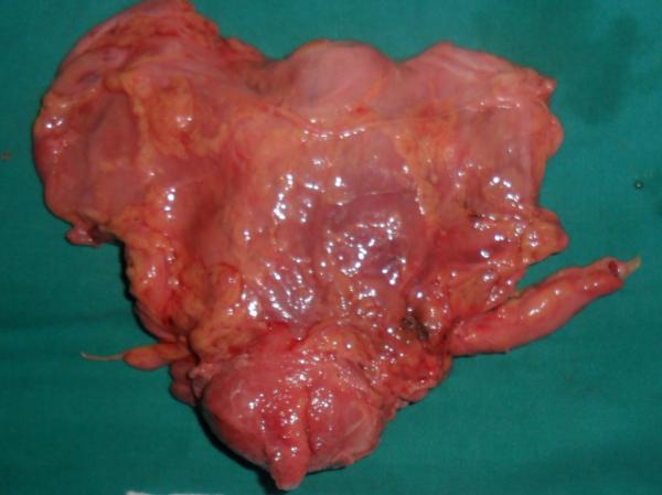cystectomy in males and anterior exenteration in females, coupled with en bloc bilateral pelvic lymphadenectomy.