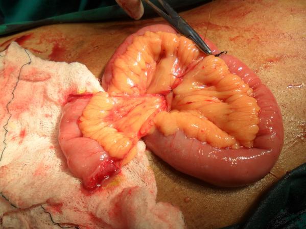 staging error. Traditionally, radical cystectomy has been associated with significant morbidity and mortality.