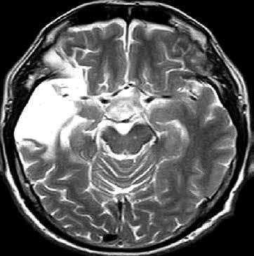 Large-vessel Right side of the temporal and parietal infarction in T2 imaging Mixed-vessel Right side of basal ganglia region infarction with cerebral white matter lesions by ventricle in FLAIR