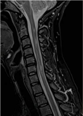 SPINAL CORD LESIONS DIAGNOSIS OF MULTIPLE SCLEROSIS Clinical diagnosis by