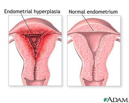 Pathologic hyperplasia is the abnormal proliferation of normal cells and can occur as a response to excessive hormonal stimulation or the effects of growth