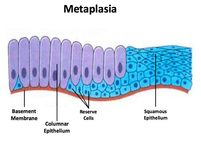 Example: replacement of normal columnar ciliated epithelial cells of the