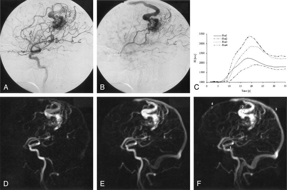 AJNR: 26, March 2005 DYNAMIC MR ANGIOGRAPHY AT 3T 631 FIG 1.