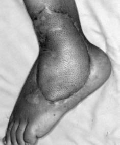 62 AM Leow et al. Journal of Orthopaedic Surgery Figure 3 Postoperative photograph of the left ankle after limb salvage surgery.
