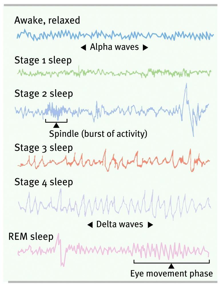 activity) Stage 3 Sleep brief; transitioning to deeper sleep Stage 4 Sleep