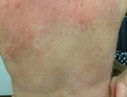 Topical steroids use the level of potency necessary to control rash, if accompanied by pruritis, use antihistamine, diphenhydramine or hydroxizine. 2.
