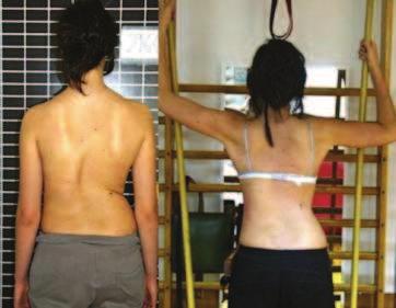 Physical Therapy for Adolescents with Idiopathic Scoliosis 15 Fig. 5.