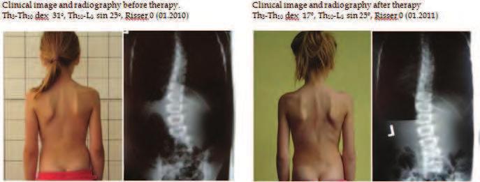 Physical Therapy for Adolescents with Idiopathic Scoliosis 29 (Bialek, 2001). In scoliosis treatment it is most desirable to correct the primary structural curve in three planes.