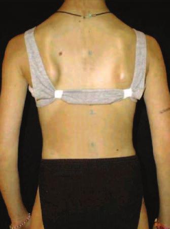 This makes each Corrective Movement specific for each type of scoliosis curve. Fig. 21. Corrective Movement and fitting of the SpineCor brace for a Right Thoracic Type 1 curve.