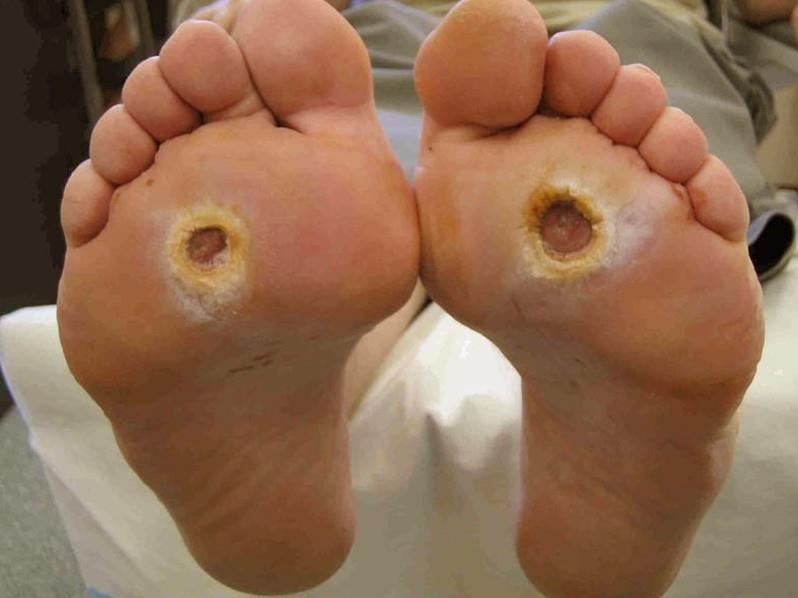 similar Diabetic Foot Ulcer (DFU)