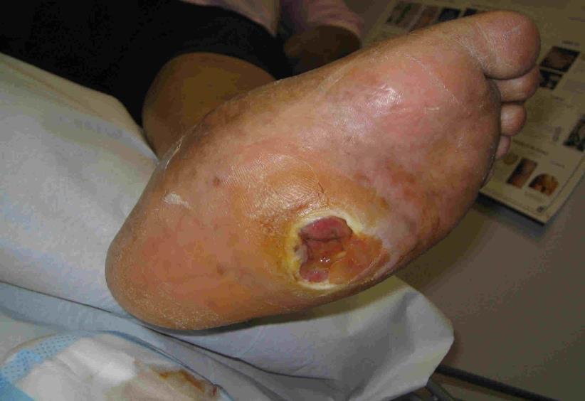 Charcot foot DFU 9 steps Step 1: Is there adequate profusion? Step 2: Is nonviable tissue present? Step 3: Are signs/symptoms of infection and/or inflammation present? Step 4: Is edema present?