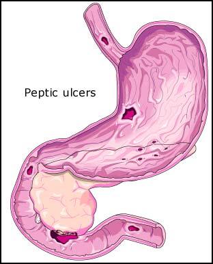 Hence we can only say that helicobacter is the expected cause of ulcers. Pathophysiology of a stomach ulcer.