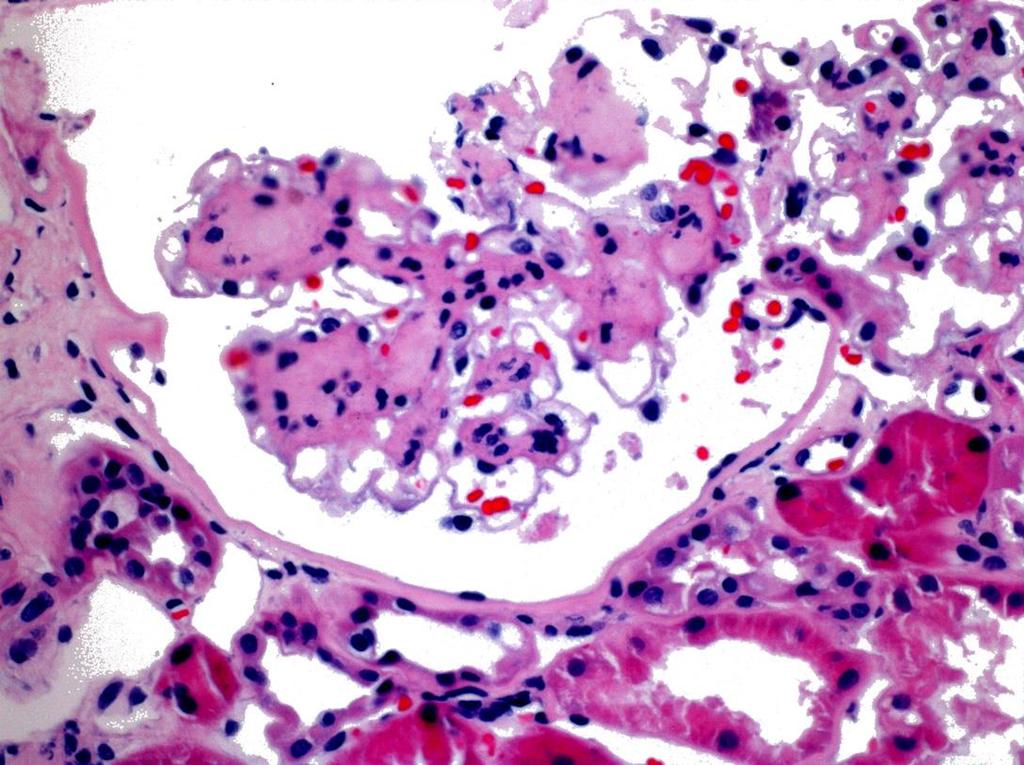 74 year old man with diabetes, HTN