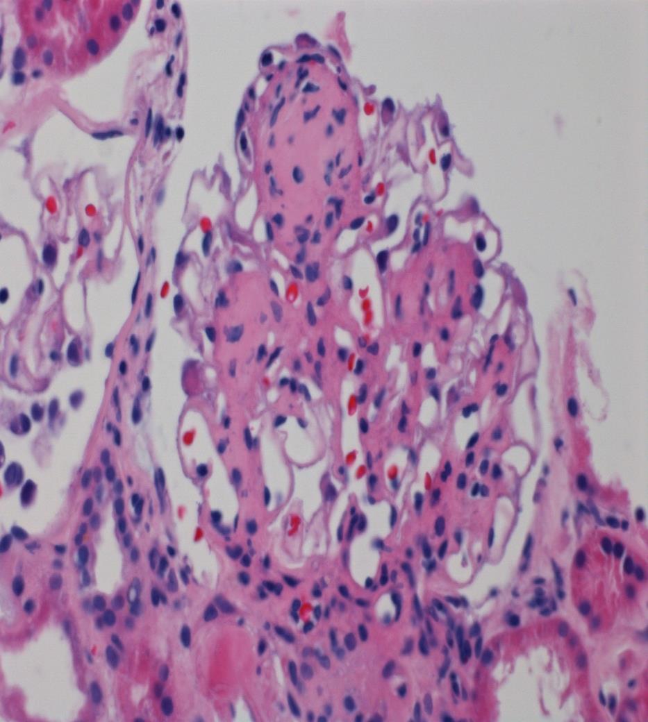 Diabetic (Kimmelsteil-Wilson) Nodules are characteristic but not always present