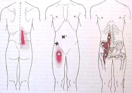 Iliopsoas trigger points Referred pain pattern for trigger points in External Oblique Trigger Point Injections