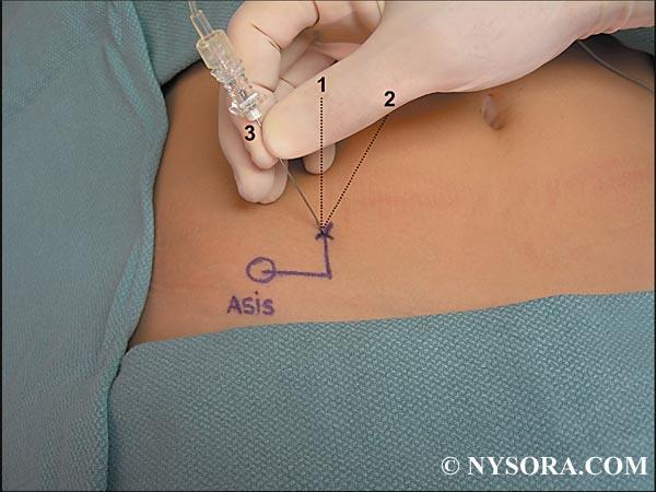 Ilioinguinal-Iliohypogastric Nerve Block Point of injection is 2 cm superior and medial to the ASIS A blunt needle
