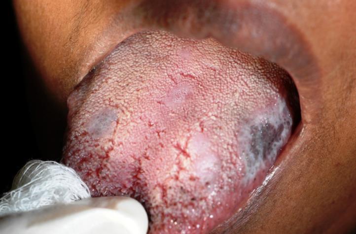 brownish hyperpigmentation and erythematous