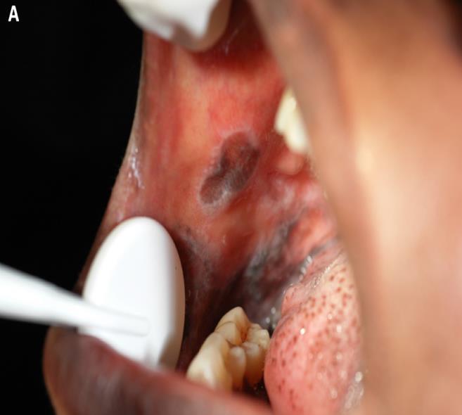 mucosa, which also extended to buccal sulcus.