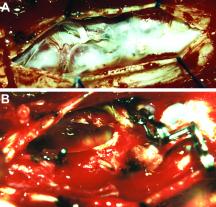 Spinal AVMs: new classification and surgical treatment FIG. 10. Intraoperative photographs. A: Perimedullary veins before occlusion of the fistula. B: Status during occlusion.