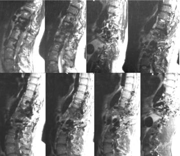 Spinal AVMs: new classification and surgical treatment FIG. 17. Preoperative MR images demonstrating an intravertebral glomus AVM with extravertebral spreading. FIG. 18.