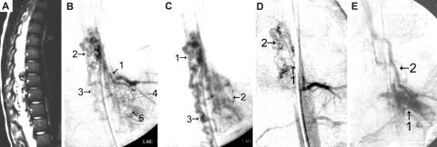 A: Preoperative MR image acquired in a T 2 -weighted sequence. B: Selective spinal angiography studies of the segmental artery, T-10 level, coursing from the left, early arterial phase.