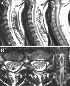 Y. P. Zozulya, E. I. Slin ko, and I. I. Al-Qashqish FIG. 1. Sagittal (A) and axial frontal (B) MR images demonstrating an intramedullary diffuse AVM at the C-5 level.