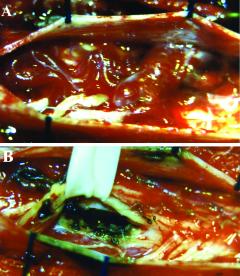 Intraoperative photographs showing an intramedullary diffuse AVM at the C-5 level. A: A conglomeration of perimedullary draining veins is seen.