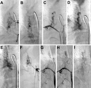 Y. P. Zozulya, E. I. Slin ko, and I. I. Al-Qashqish FIG. 5. Selective spinal angiography studies of an intramedullary glomus AVM demonstrating four tributaries.