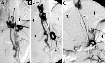 Spinal AVMs: new classification and surgical treatment FIG. 8. Selective spinal angiography studies demonstrating a perimedullary AVM at the T10 L2 level.