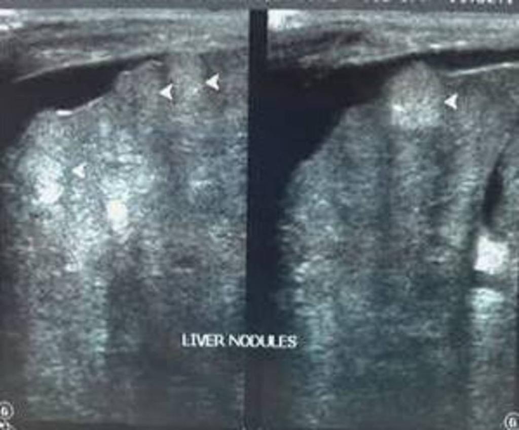 Fig. 1: Ultrasonography section of liver shows multiple