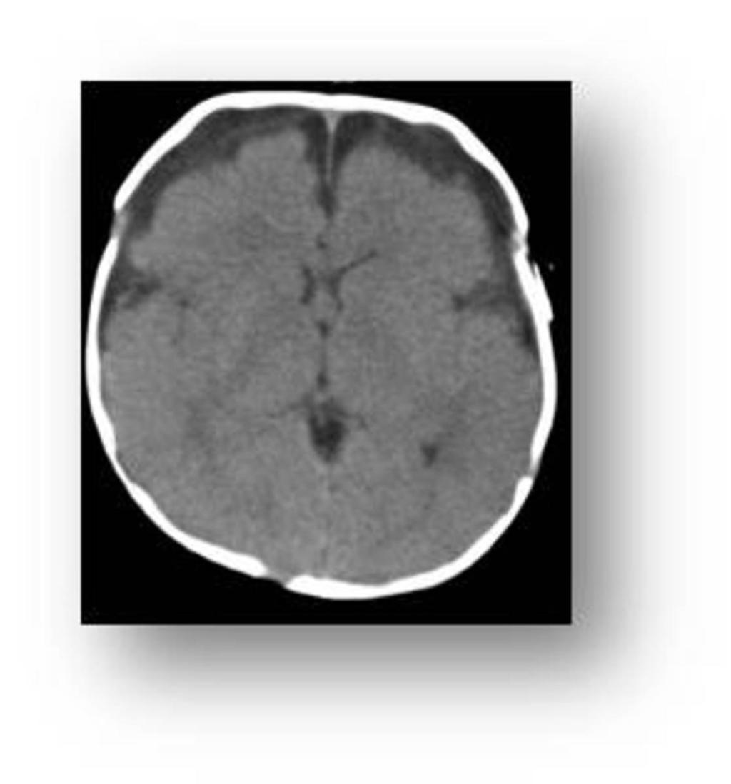 Fig. 3: Axial CT scan of brain showed symmetrical