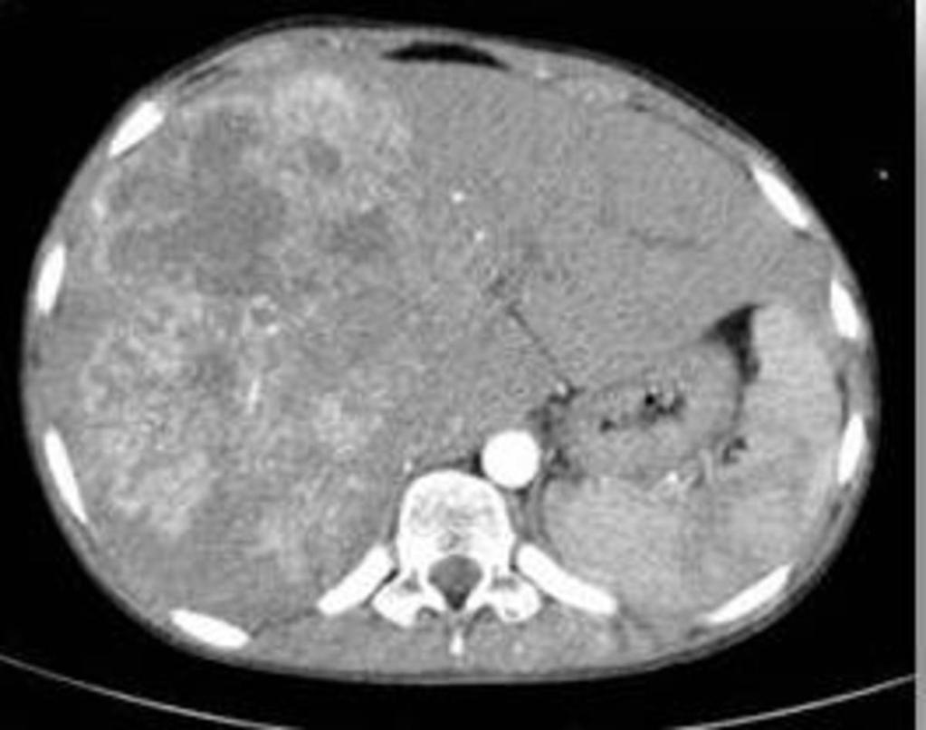 Fig. 4: Axial Contrast enhanced CT scan image of liver showed nodular heterogeneously enhancing space