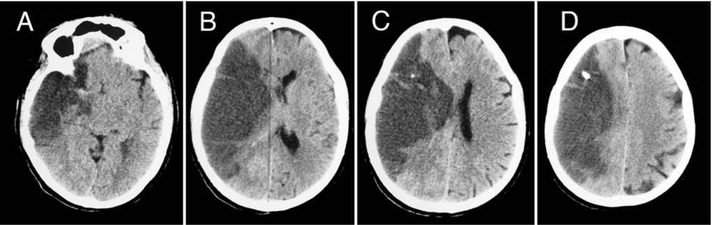 Patients with a malignant MCA infarction may show ICP values < 20 mm Hg despite marked MLS (> 5 mm), large brain infarctions, and neurological deterioration
