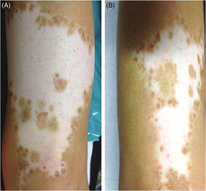 Epidermal micrografts in vitiligo A. Janowska et al. Figure 4 Representative photo of 50 75% repigmentation.